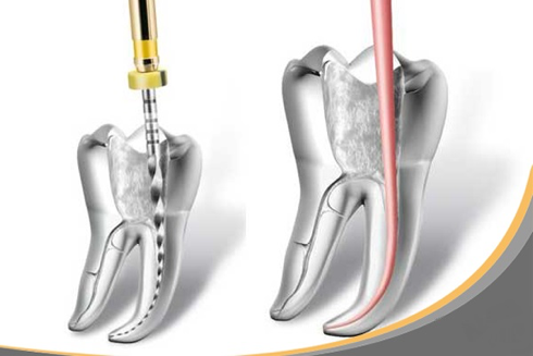 Proceso de endodoncia